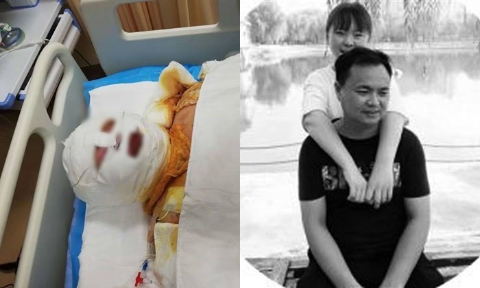 พ่อยอมเฉือนผิวหนังรักษาลูกสาวโดนไฟคลอกทั้งตัว แม่จำใจโกหก พ่อไปทำงานต่างจังหวัด