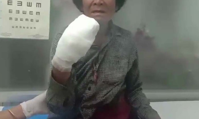 อุทาหรณ์ ยายเมืองชลปาระเบิดปิงปองไล่นก พลาดบึ้มใส่มือนิ้วขาดเกือบหมด