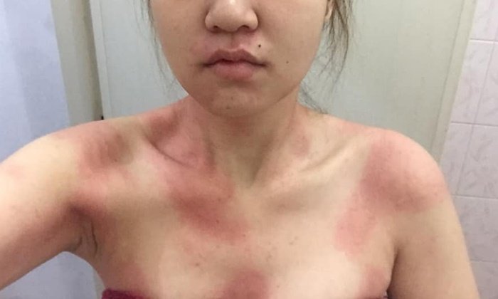 เปิดใจ 2 สาวนครปฐม ร่างทรุดฝุ่น PM 2.5 เลือดทะลัก-ลมพิษเล่นงาน จนหมอแนะย้ายถิ่น