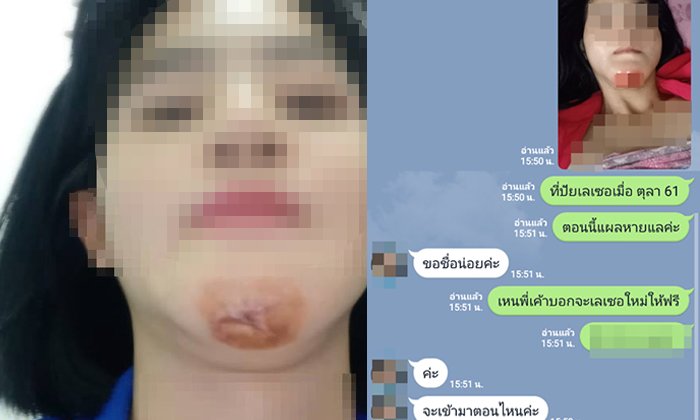 เตือนภัยคนอยากสวย! สาวทำเลเซอร์ "คางไหม้" คลินิกปัดรับผิดชอบ ให้แค่ยาทา