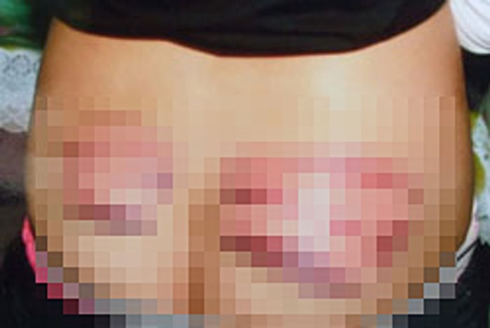 ครูโหด! ตีเด็กหญิง12 เป็นรอยช้ำ-จับไข้