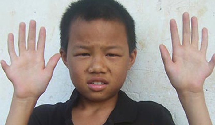ตะลึง! เด็กจีนพิเศษ มีนิ้วเท้าโผล่รวม 24 นิ้ว