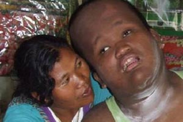 สุดยอดแม่! กัดฟันเลี้ยงลูกพิการนานกว่า 16 ปี