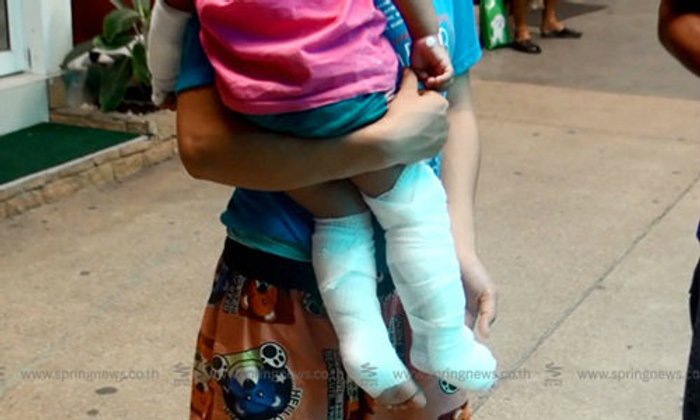 อุทาหรณ์! ปล่อยลูกวัยขวบเศษเล่นขวดน้ำกรด พลัดตกโดนตัวเจ็บสาหัส