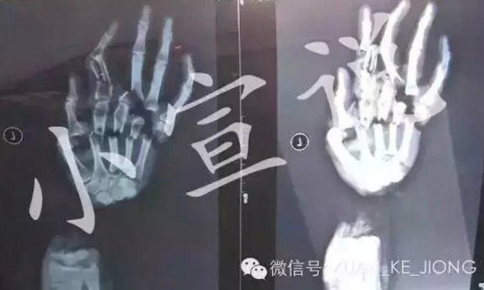 ผัวจีนโหดฟันมือเมียขาด หลังกล่าวหาแอบมีชู้
