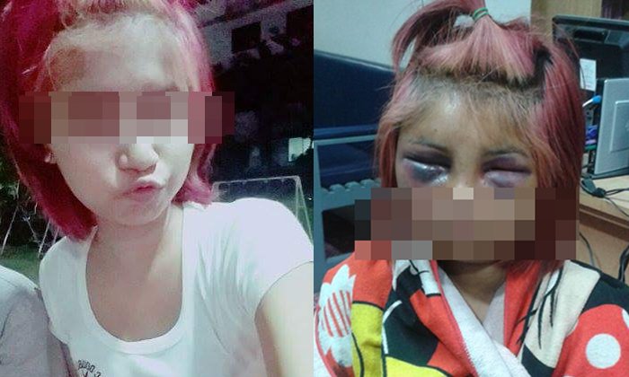 สาว 16 ถูกเพื่อนรุมซ้อมปางตาย หน้าตาบวมปูดไม่เหลือเค้าเดิม