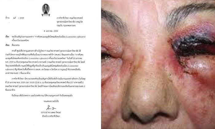 พบแมงมุมพิษรุนแรงในไทย ถูกกัดทำให้เกิดแผลเน่าดำ