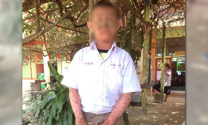 ชาวเน็ตส่งกำลังใจ น้องไอซ์ เด็กผิวตกสะเก็ด แม่บอกได้แค่ "อดทนนะลูก"