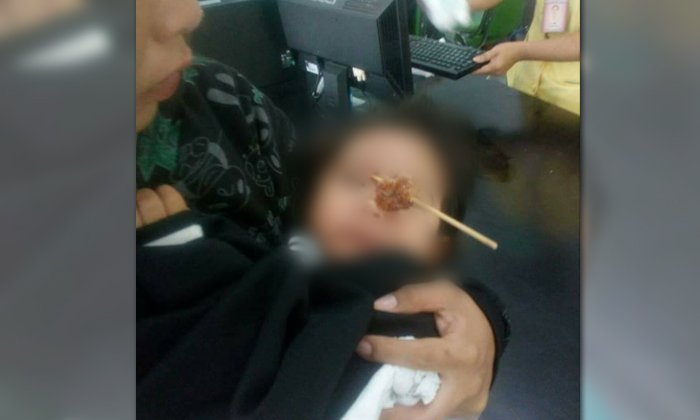 อุทาหรณ์สุดเสียว เด็กหญิงกินหมูปิ้งเอง ไม้เสียบเฉียดดวงตา