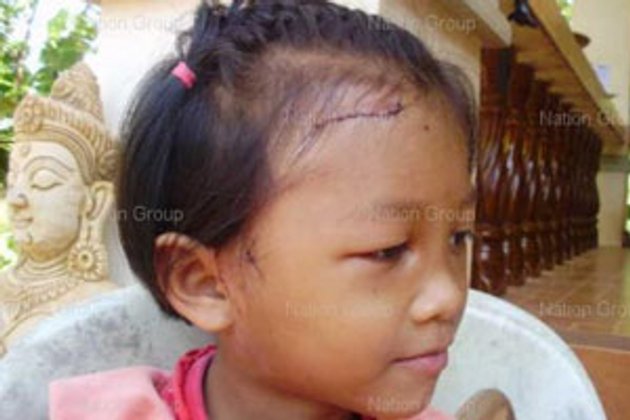อัลเซเชี่ยนขย้ำเด็กหญิงสกลนคร 6 ขวบเย็บ 10 เข็ม