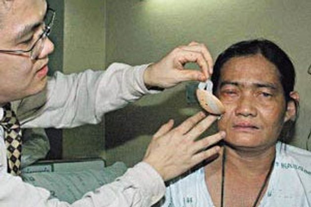 หมอราชวิถีผ่าตัดตาช่วย ดอกรัก มองเห็น