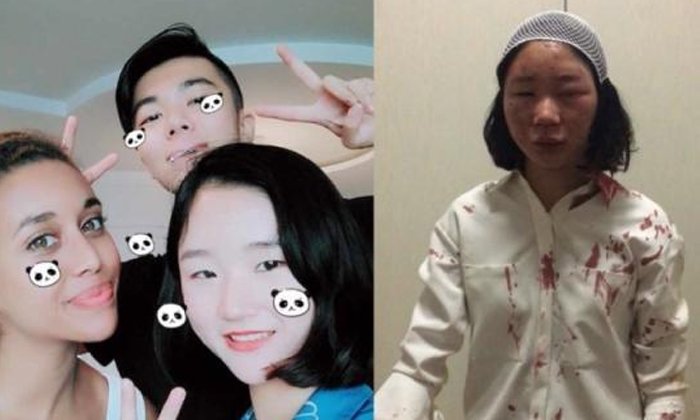 สาวจีนมึน! เดินเที่ยวอยู่ดีๆ ถูกชน-ตีหัวแตก เย็บ 6 เข็ม