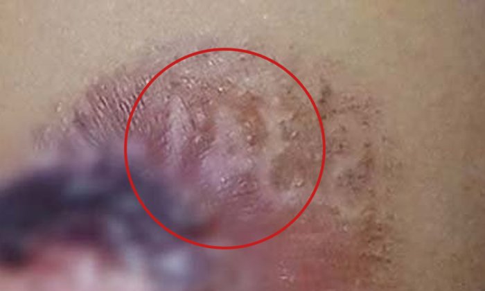 ถูกจริง! เด็กหญิงขาโดนท่อไอเสีย ตัวเลขบนแผลตรงรางวัลที่ 1