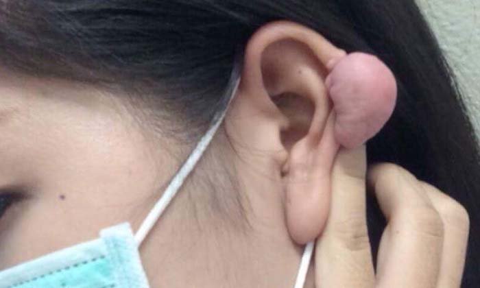 เปิดใจ นศ.สาวเจาะหูแฟชั่น ถอดต่างหูเพื่อขึ้นเวทีนางงาม แล้วเกิดอักเสบ
