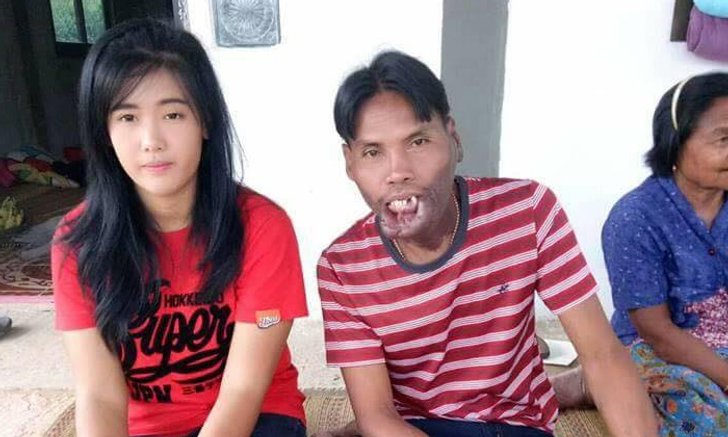รักกันที่หัวใจ หนุ่มใบหน้าพิการแต่งงานกับสาวสวย หนุ่มๆ อิจฉาทั้งหมู่บ้าน