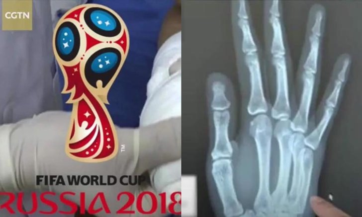 เจ็บนี้อีกนาน หนุ่มจีนเชียร์ฟุตบอลโลก ลุ้นหนักจน “มือหัก”