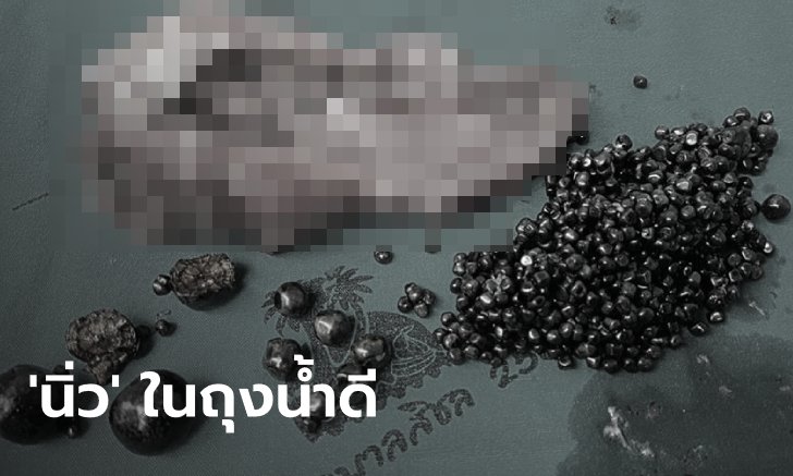 หมอยังตะลึง คนไข้สาวเจ็บหน้าอก-จุกแน่น ผ่าตัดเจอก้อนนิ่วในถุงน้ำดี 861 เม็ด