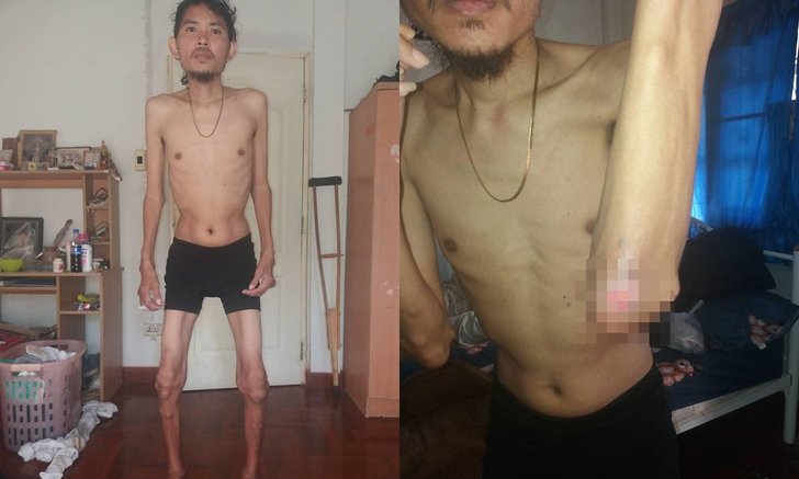 "เควิน วงโปงลางสะออน" ป่วยหนัก ร่างกายเป็นแผลทั่วตัว-ซูบผอมเหลือแต่กระดูก