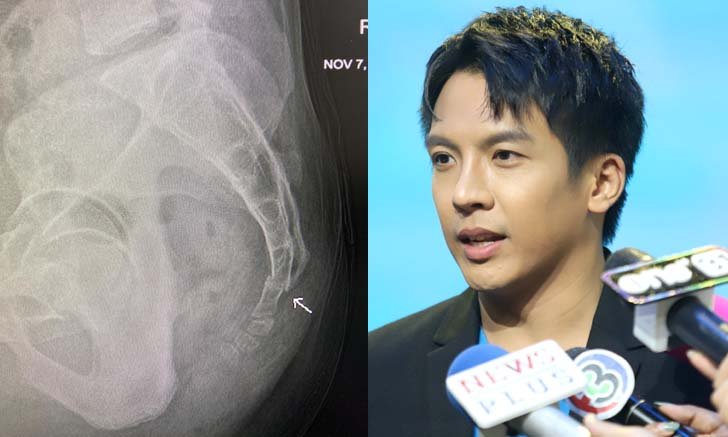 "เต๋า ภูศิลป์" ทำแฟนๆ ใจหายวาบ เผยภาพเอ็กซเรย์ ตกบันไดกระดูกแตกและร้าว