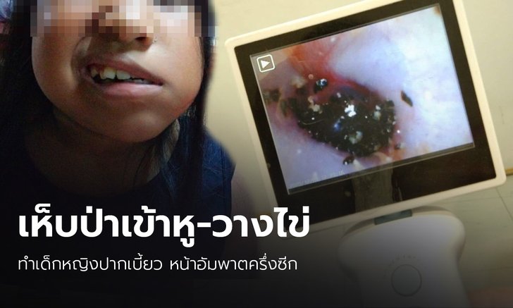 เด็กหญิงถูก "เห็บป่า" ออกลูกวางไข่ในหู ทำปลายประสาทอักเสบ-หน้าเบี้ยว