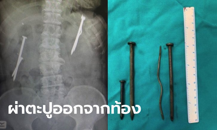 ตาวัย 75 เครียดโควิด กลืนตะปู-ลวดเหล็ก หวังฆ่าตัวตาย สุดท้ายปวดท้องหนักต้องผ่าตัด
