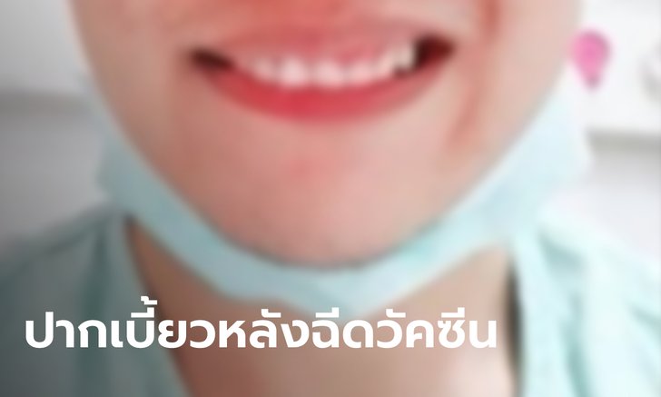 โผล่อีกเคส! พยาบาลหนุ่มฉีดวัคซีนซิโนแวค ปากเบี้ยว-แขนขาอ่อนแรง วอนเยียวยา