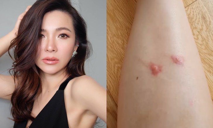 "ดีเจต้นหอม" เผยรอยโดนยุงกัดทั่วขา เป็นตุ่มใหญ่มาก แฟนๆ แห่เป็นห่วง