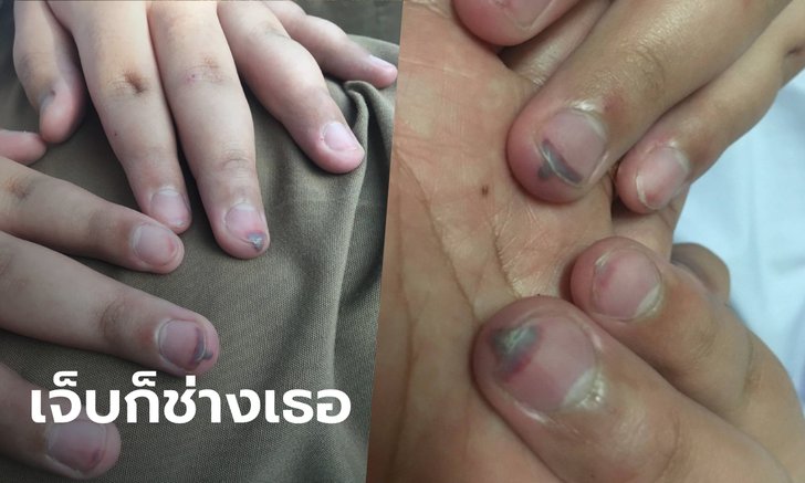 แม่รับไม่ได้ ครูทำโทษนักเรียน ป.6 ให้ทำมือจีบ เอาแปรงลบกระดานตีจนห้อเลือด