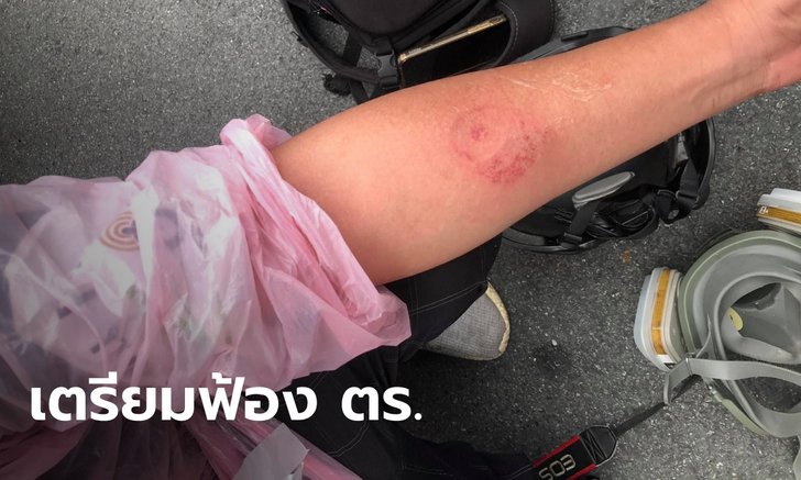 2 สื่อมวลชน จ่อฟ้องเรียกค่าเสียหายตำรวจ หลังถูกยิงกระสุนยางใส่จนบาดเจ็บ