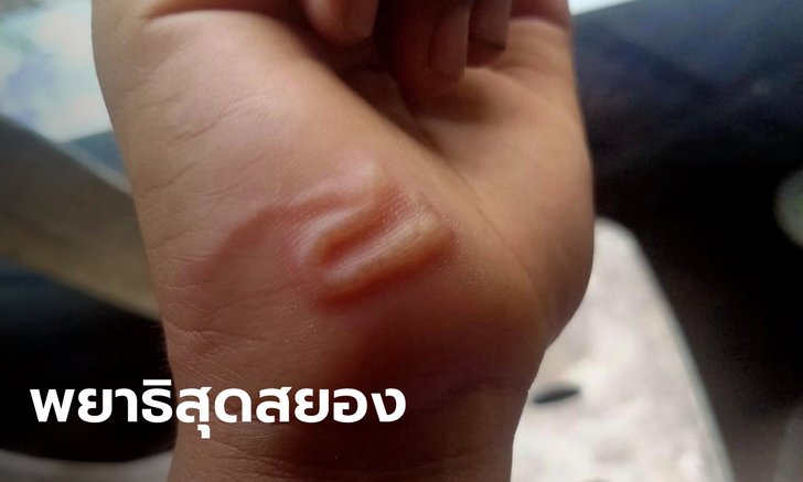 สยอง..แชร์ว่อนภาพพยาธิไชมือเด็ก เติบโตใต้ผิวหนัง เตือนระวังมากับน้ำสกปรก