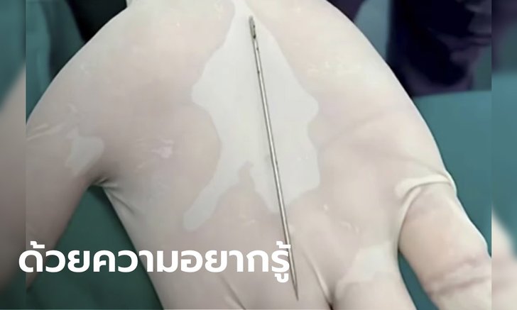 เด็กจีนวัย 13 ปี ยัดเข็มยาว 9 ซม. เข้าหนอนน้อย ทนเจ็บครึ่งเดือน กว่าจะไปหาหมอ