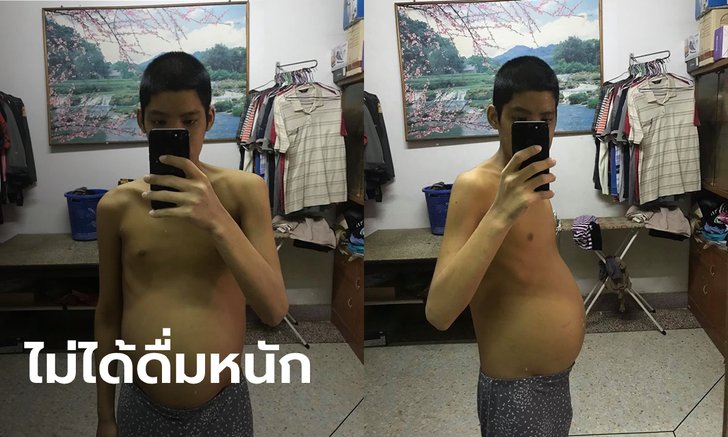 นักกีฬาว่ายน้ำจู่ๆ ป่วยโรคตับแข็ง เพราะดื่มเบียร์ขวดเดียวทำให้รู้ ทรมาน 6 ปี ก่อนสิ้นใจ