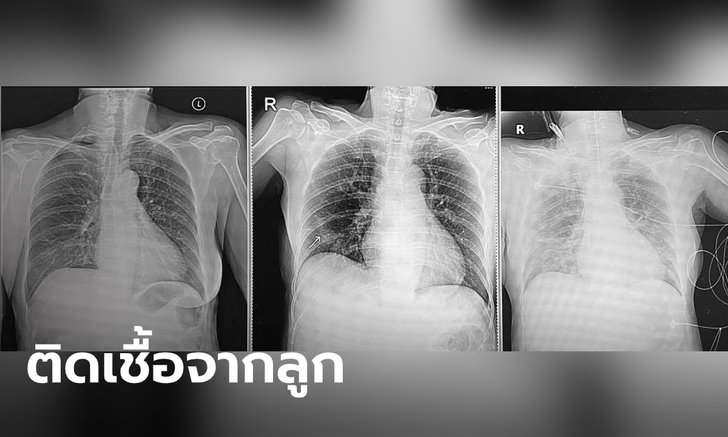 หมอโพสต์อุทาหรณ์ แม่ติดโควิด-19 อาการหนัก ติดจากลูกสาวที่ไม่ยอมกักตัว