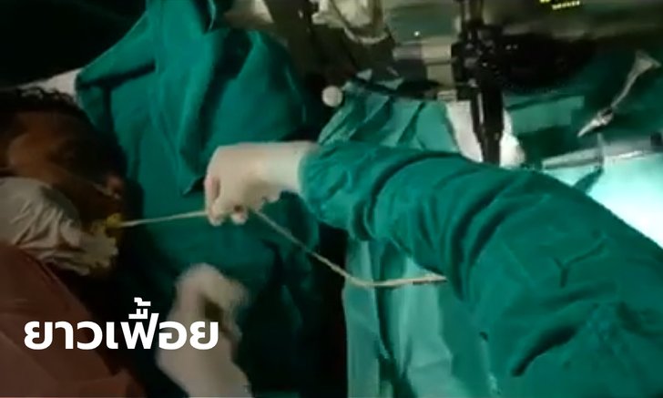 เปิดคลิปแพทย์ดึงพยาธิตืดหมูจากปากคนไข้ เตือนคนชอบเปิปของสุกๆ ดิบๆ