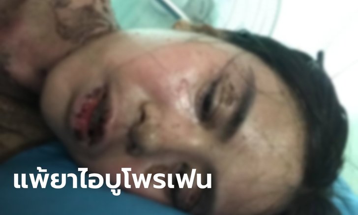 สาวโพสต์อุทาหรณ์ ปวดฟันซื้อ "ยาไอบูโพรเฟน" มากินเอง แพ้ยาหนักผิวไหม้ทั้งตัว