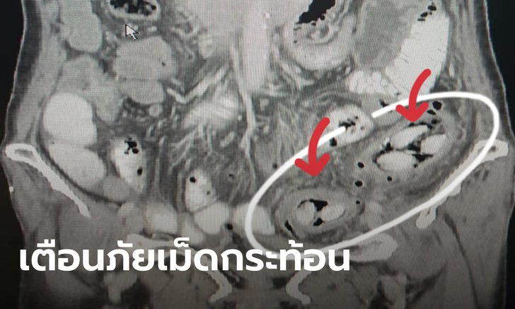 หมอโพสต์เตือน กลืนเม็ดกระท้อนลงท้อง เสี่ยงทำลำไส้ทะลุ อันตรายถึงชีวิต