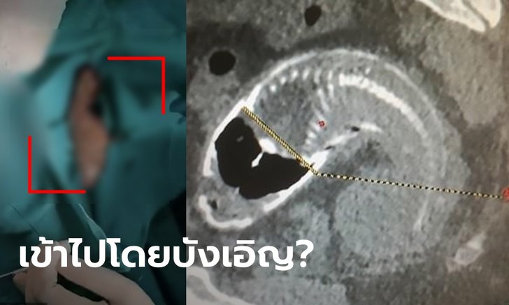 ช็อก! หนุ่มปวดท้องปริศนา เอ็กซเรย์ดูถึงกับเหวอ เจอปลาหมอหลุดเข้ารูทวาร