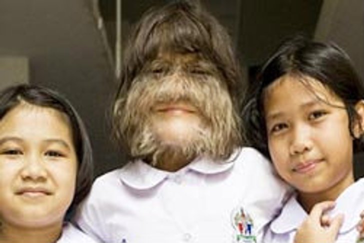 น้องแนท เด็กขนยาวที่กินเนสส์ต้องจารึก
