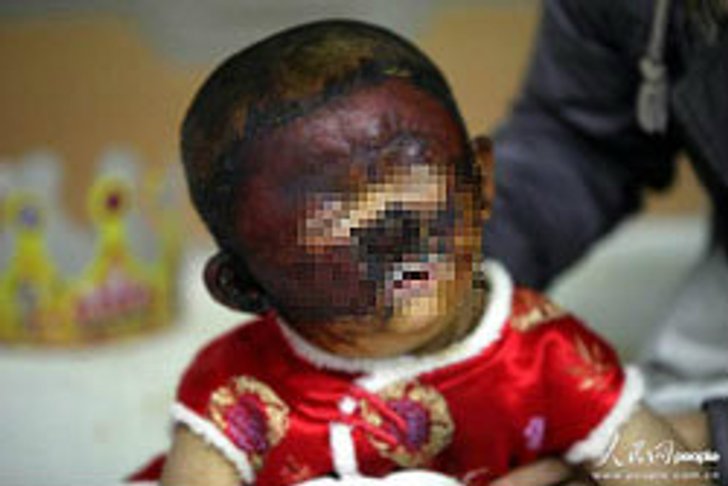พ่อเลี้ยงจีนโหด! จับลูก3ขวบ ราดน้ำมันจุดไฟเผา