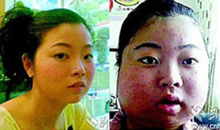 แปลก! ป่วยหน้าบวมเหมือนพระจันทร์