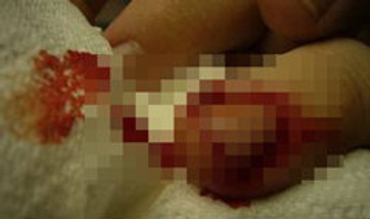 ลูกป่วยอาการทางจิต ฉุนแม่ตำหนิจับแม่สับนิ้วขาด ปาดคอ