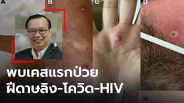 "ดร.อนันต์" เผย พบผู้ป่วยชายในอิตาลี ติดเชื้อฝีดาษลิง-โควิด และ HIV พร้อมกัน