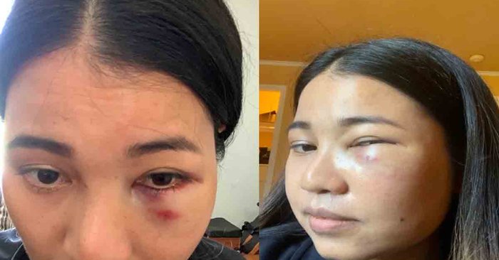 หญิงไทยในซานฟรานฯ เผยนาทีชีวิตถูกทำร้ายบนรถไฟ ระวังเต็มที่แล้วยังไม่รอด