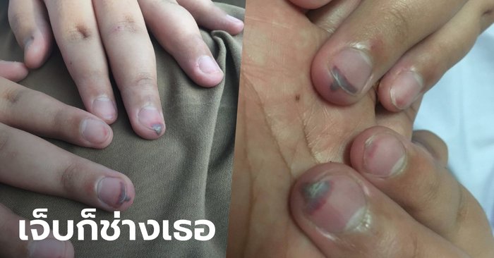 แม่รับไม่ได้ ครูทำโทษนักเรียน ป.6 ให้ทำมือจีบ เอาแปรงลบกระดานตีจนห้อเลือด