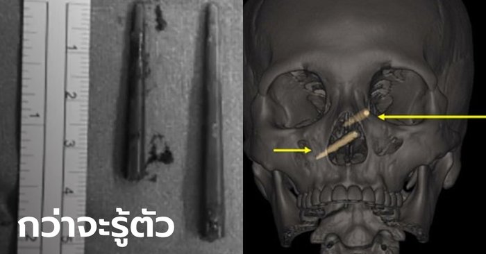 อึ้ง! สาวไต้หวันมีเศษตะเกียบพลาสติกฝังในกะโหลก คาไว้ 1 สัปดาห์กว่าจะรู้ตัว