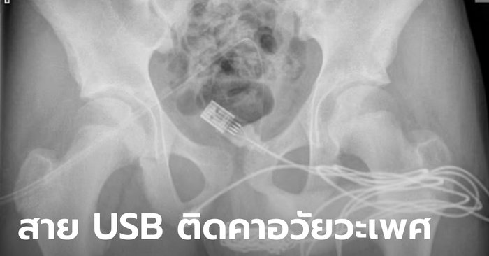 สภาพ! เด็กหนุ่มวัย 15 ปี สอดสาย USB เข้าอวัยวะเพศเพื่อวัดขนาด สุดท้ายเอาออกไม่ได้