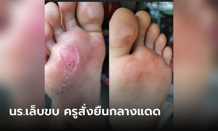 ผปค.ร้อง ลูกเล็บขบใส่แตะไปเรียน ครูสั่งถอดยืนกลางแดด สุดท้ายเท้าพองแบบนี้