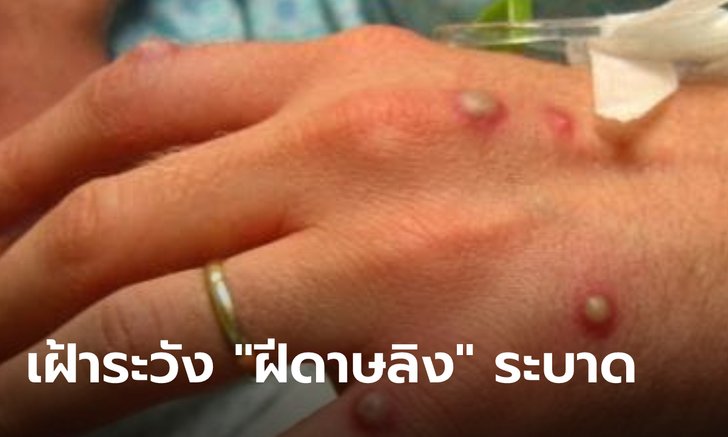 ยุโรป-อเมริกาเหนือ ผวา! พบผู้ป่วย "โรคฝีดาษลิง" หลายสิบคน หวั่นระบาดในท้องถิ่น