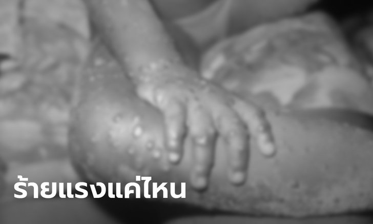 ฝีดาษลิงร้ายแรงแค่ไหน? ระบาดลามเกิน 19 ประเทศใน 3 ทวีป
