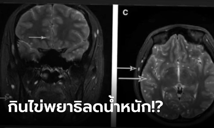 หมอแล็บฯ เผย ผู้ป่วยอยากผอม เอาไข่พยาธิมากิน สุดอันตรายอย่าหาทำ!